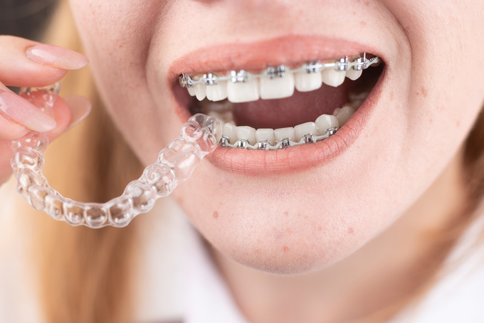Mujer con la boca abierta mostrando su aparato dental