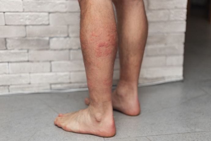 Hombre con manchas rojas en los pies